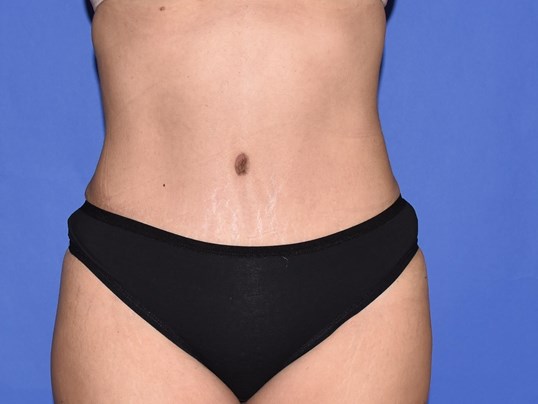 HoustonUnBotched: Tummy Tuck Scar Revision, bikini, summer, #HoustonUnBotched! This patient had a tummy tuck elsewhere. Unfortunately,  she experienced tissue necrosis. After many weeks of wound care, she ended  up