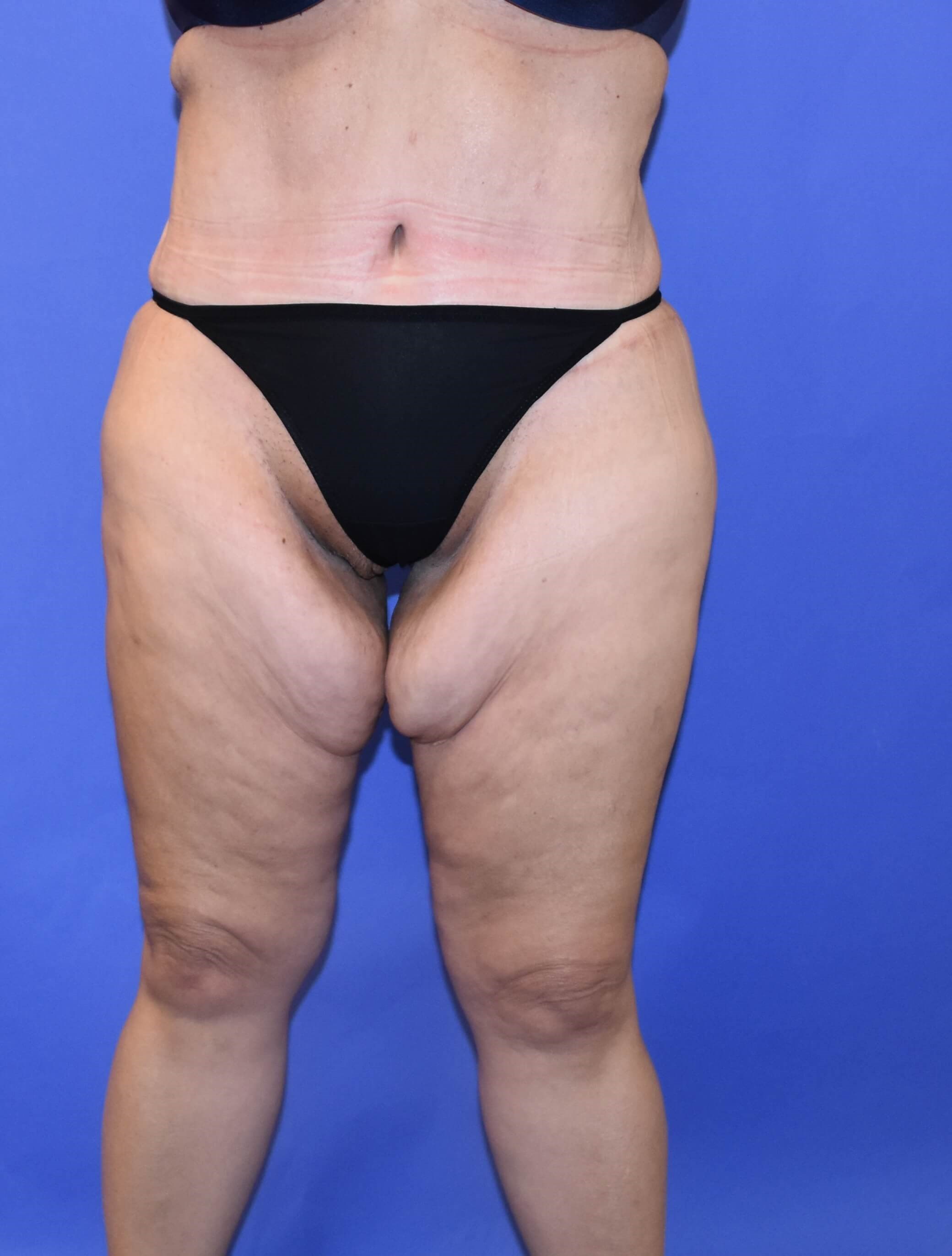 Post Weight Loss Inner Thigh Lift performed on Houston area female