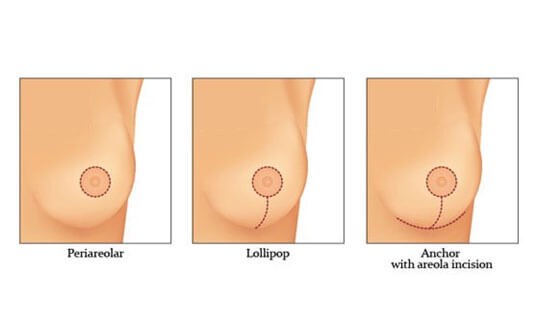 Breast Lift Incision Placement