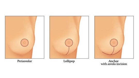 Are There Weight Considerations for a Mastopexy?