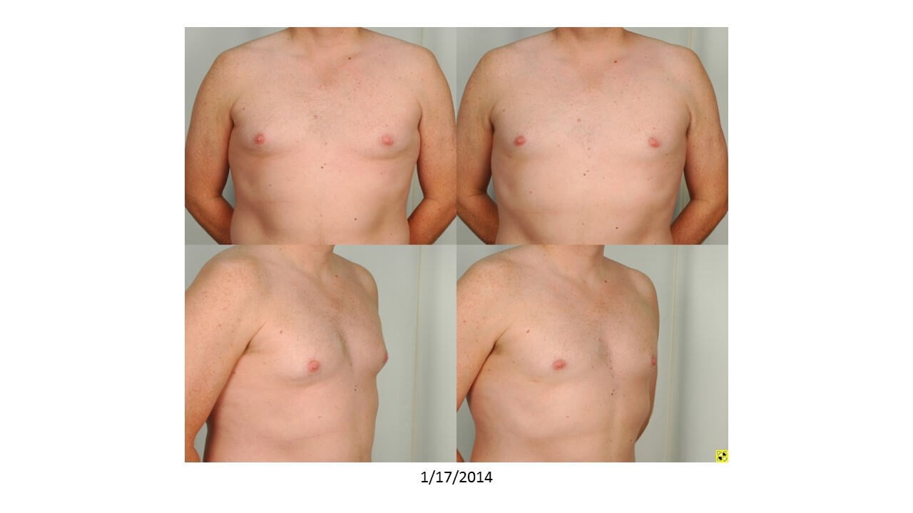 104.1 KRBE Producer Eric in Houston has Gynecomastia surgery